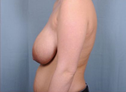 Breast Reduction Before & After Patient #4132