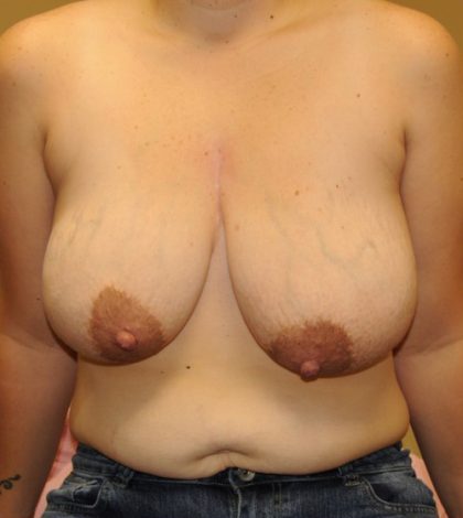 Breast Reduction Before & After Patient #4133