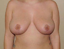 Breast Reduction Before & After Patient #4134