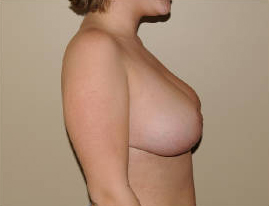 Breast Reduction Before & After Patient #4134