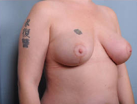 Breast Reduction Before & After Patient #4136