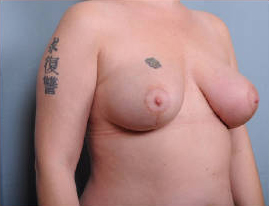 Breast Reduction Before & After Patient #4136