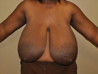 Breast Reduction Before & After Patient #4120
