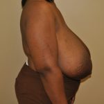 Breast Reduction Before & After Patient #4120