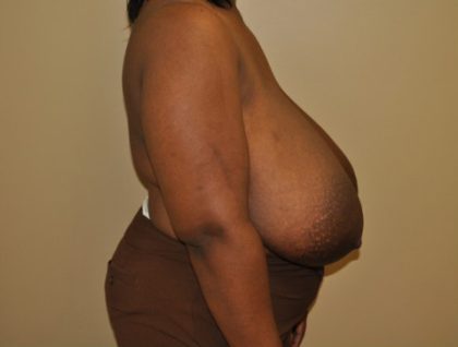 Breast Reduction Before & After Patient #4120