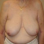 Breast Reduction Before & After Patient #4127