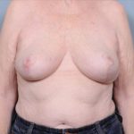 Breast Reduction Before & After Patient #4127