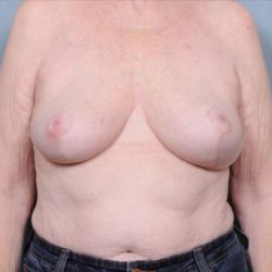 Breast Reduction Before & After Patient #4127