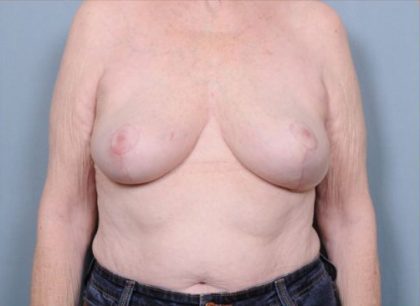 Breast Reduction Before & After Patient #4127