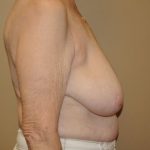 Breast Reduction Before & After Patient #4127