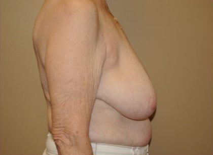 Breast Reduction Before & After Patient #4127