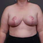 Breast Lift / Mastopexy Before & After Patient #4474