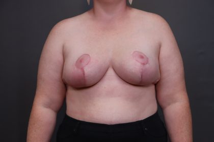 Breast Lift / Mastopexy Before & After Patient #4474