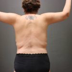 Brachioplasty Before & After Patient #3982