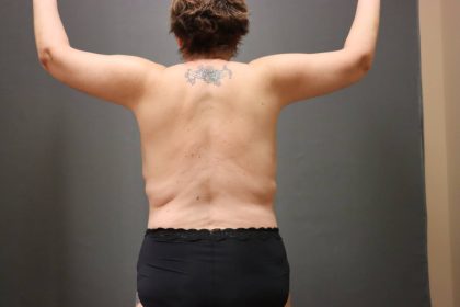 Brachioplasty Before & After Patient #3982