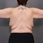 Brachioplasty Before & After Patient #3982