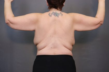 Brachioplasty Before & After Patient #3982