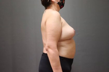 Brachioplasty Before & After Patient #3982