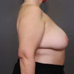 Brachioplasty Before & After Patient #3982