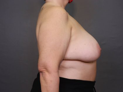 Brachioplasty Before & After Patient #3982
