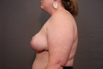 Breast Reduction Before & After Patient #3961