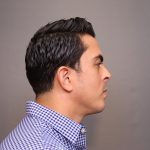 Chin Implants Before & After Patient #3703
