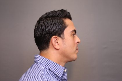 Chin Implants Before & After Patient #3703