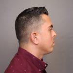 Chin Implants Before & After Patient #3703
