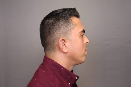 Chin Implants Before & After Patient #3703