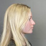 Rhinoplasty Before & After Patient #4439