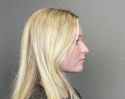Rhinoplasty Before & After Patient #4439