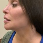 Dimple Creation Before & After Patient #3729