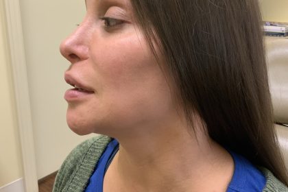Dimple Creation Before & After Patient #3729