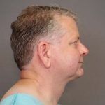 Earlobe Repair Before & After Patient #4368