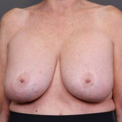 Implant Removal Before & After Patient #4233
