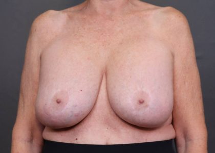 Implant Removal Before & After Patient #4233