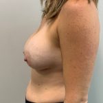 Implant Removal Before & After Patient #4232