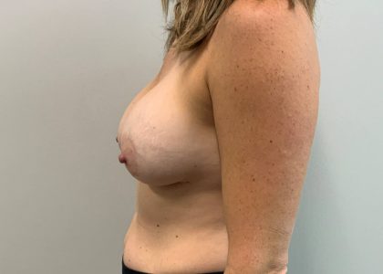 Implant Removal Before & After Patient #4232