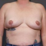Implant Removal Before & After Patient #4231