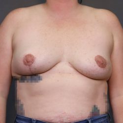 Implant Removal Before & After Patient #4231
