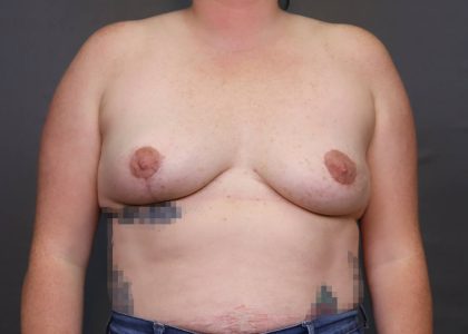 Implant Removal Before & After Patient #4231