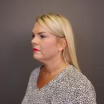 Facelift Before & After Patient #4348