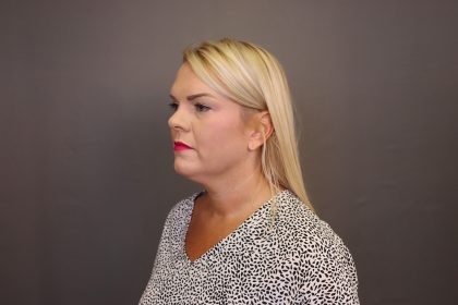 Facelift Before & After Patient #4348