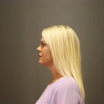 Facelift Before & After Patient #4348