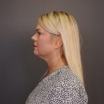 Facelift Before & After Patient #4348