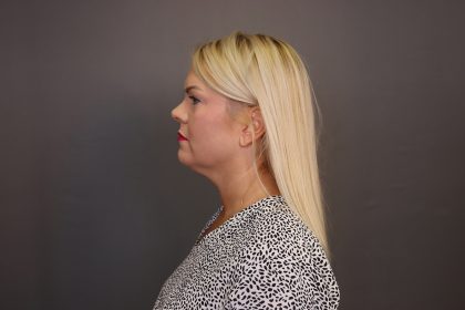Facelift Before & After Patient #4348