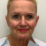 Facelift Before & After Patient #4350