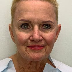 Facelift Before & After Patient #4350