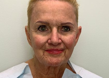 Facelift Before & After Patient #4350