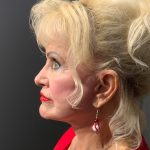 Facelift Before & After Patient #4350